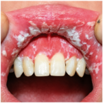 candidiasis