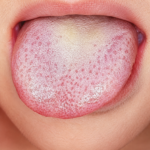 candidiasis 2