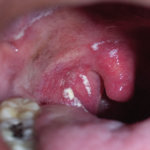 candidiasis 3