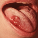 chlamydia