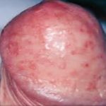 chlamydia_3_full_300x300